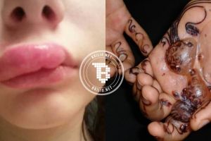 13 Foto ini jadikan kamu pantang sepelekan alergi, bikin batal cantik!