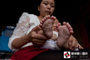 Bayi ini lahir dengan 15 jari tangan dan 16 jari kaki