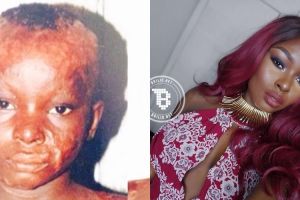 Luka bakar di seluruh wajah, wanita ini sukses jadi beauty blogger