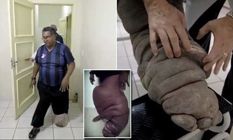 Pria ini 20 tahun hidup dengan penyakit kaki gajah, kasihan banget