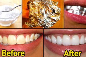 Ternyata memutihkan gigi bisa pakai aluminium foil, kamu berani coba?