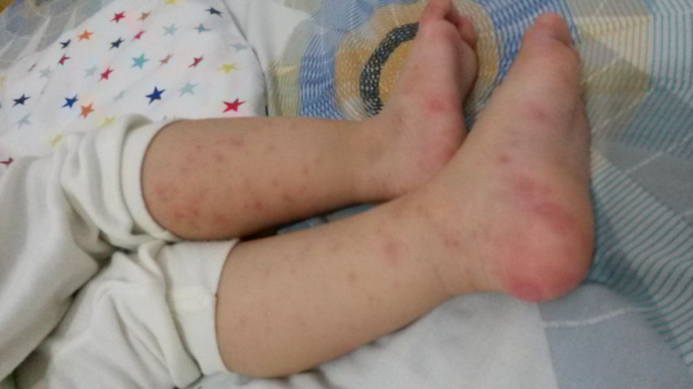 Ciri Flu Singapura Pada Orang Dewasa - Ini Cirinya