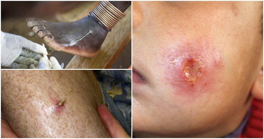 10 Parasit mengerikan ini bisa menyerangmu kapan saja, hati-hati ya!