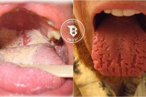 8 Kondisi lidah ini tunjukkan status kesehatanmu, yuk cek!