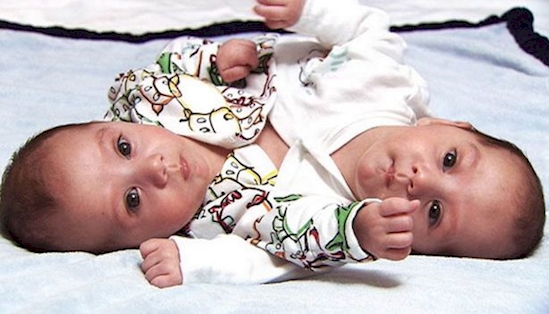 kisah kembar siam © 2016 brilio.net kisah kembar siam © 2016 brilio.net