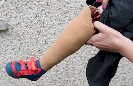 kisah kembar siam © 2016 brilio.net kisah kembar siam © 2016 brilio.net