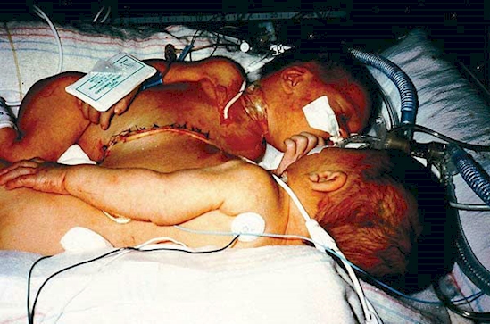 kisah kembar siam © 2016 brilio.net kisah kembar siam © 2016 brilio.net