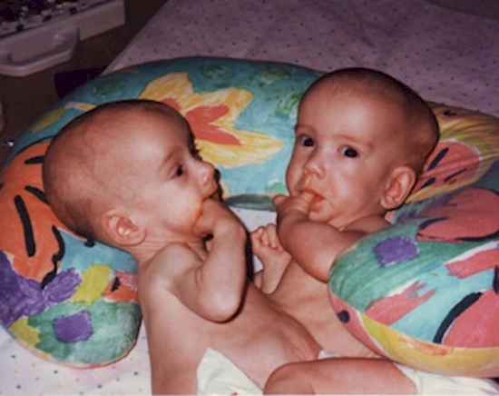 kisah kembar siam © 2016 brilio.net kisah kembar siam © 2016 brilio.net