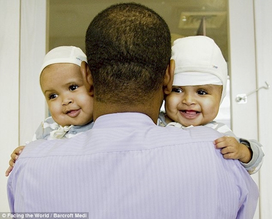 kisah kembar siam © 2016 brilio.net kisah kembar siam © 2016 brilio.net