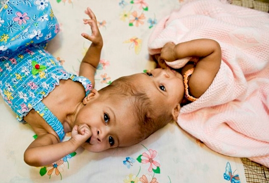 kisah kembar siam © 2016 brilio.net kisah kembar siam © 2016 brilio.net