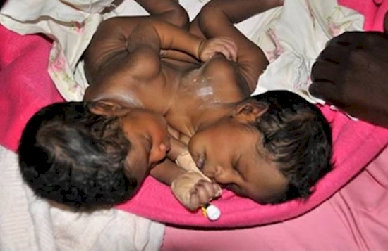 kisah kembar siam © 2016 brilio.net kisah kembar siam © 2016 brilio.net