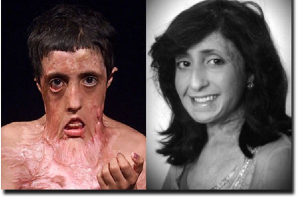 Bikin terenyuh, upaya gadis ini untuk cantik usai wajahnya terbakar