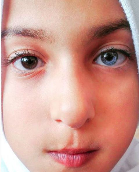 Heterochromia Iridium © 2016 brilio.net Heterochromia Iridium © 2016 brilio.net