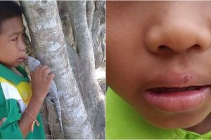 Malangnya nasib bocah ini, bibir jontor gara-gara digigit tokek