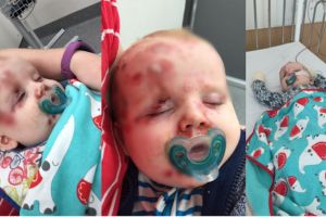 Tidak diimunisasi, sekujur tubuh bayi ini terserang campak mengerikan