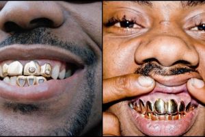 Kawat gigi udah biasa, ini lho penampilan 14 orang pakai gigi emas