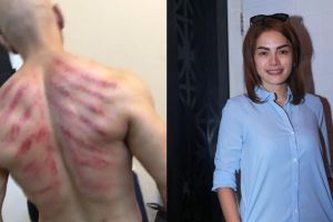 5 Selebriti ini hobi kerokan, wah wah masuk angin nih? 