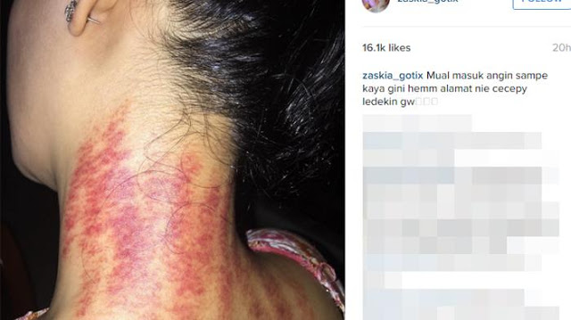 artis kerokan  © 2016 brilio.net