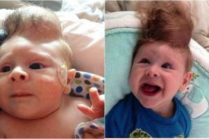 Kisah bayi terlahir dengan kelainan otak ini bikin haru