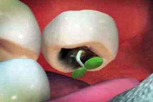 Malas menyikat gigi, tunas jambu biji tumbuh di mulut pria ini, duh!