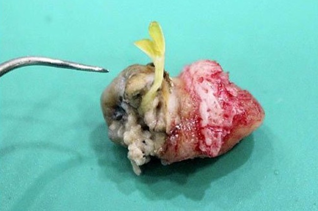 Malas menyikat gigi, tunas jambu biji tumbuh di mulut pria ini, duh!