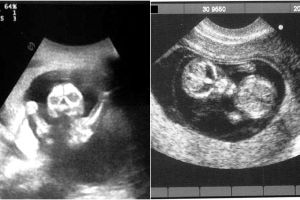 10 Foto USG bayi ini bikin merinding, mirip karakter film horor