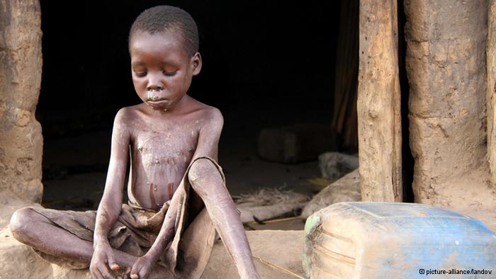 anak kelaparan afrika © 2016 brilio.net