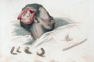 7 Pengobatan sadis bagi penderita gangguan jiwa zaman dulu, seram abis