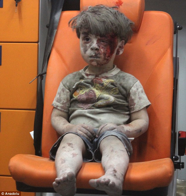 Kondisi bocah akibat konflik Suriah ini bikin meneteskan air mata