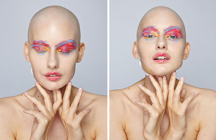 7 wanita penderita © 2016 brilio.net