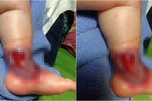 Diduga korban malpraktik, bayi ini alami infeksi serius