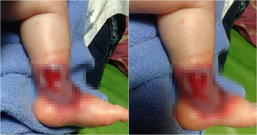 Diduga korban malpraktik, bayi ini alami infeksi serius