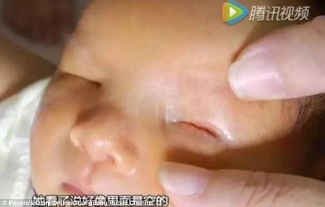 Bayi mungil nan menggemaskan ini lahir tanpa mata