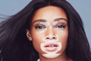 Winnie Harlow, model cantik ini buktikan pengidap vitiligo bisa sukses