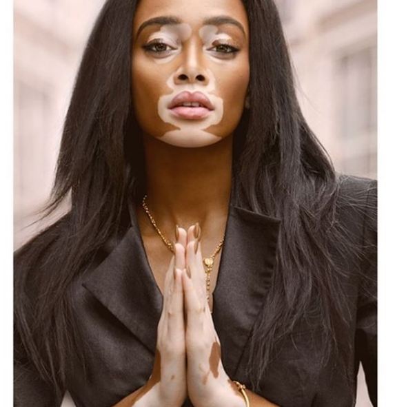 Winnie Harlow © 2016 Instagram