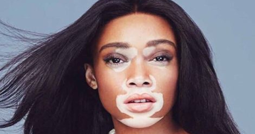 Winnie Harlow, model cantik ini buktikan pengidap vitiligo bisa sukses