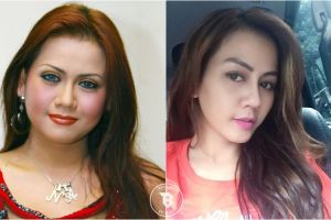 4 Potret sebelum & sesudah artis operasi plastik, makin cantik nggak?