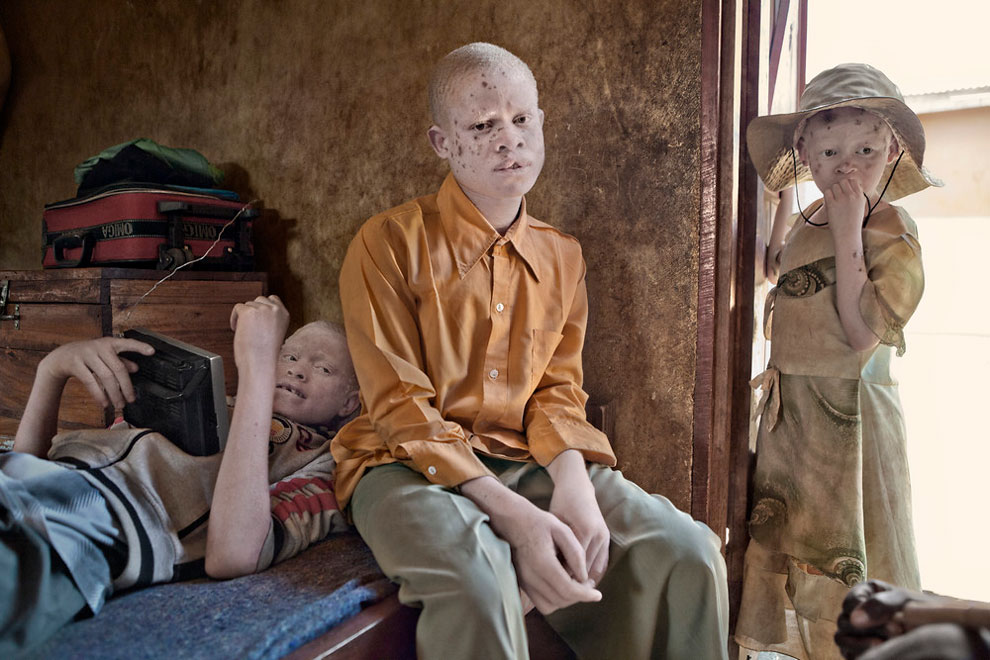 Sering jadi tumbal, 17 potret orang albino di Afrika ini sungguh miris