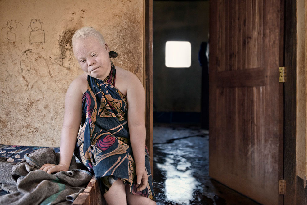 Sering jadi tumbal, 17 potret orang albino di Afrika ini sungguh miris
