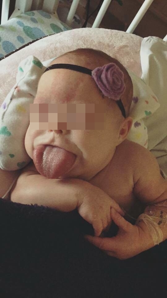 Punya ukuran lidah dewasa, bayi ini bisa tersenyum setelah dioperasi
