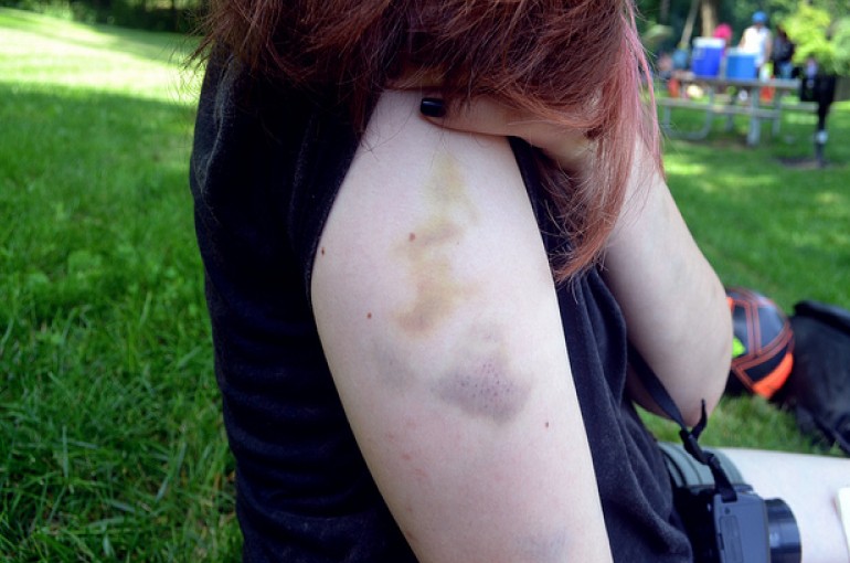 cedera masa kecil  © 2016 brilio.net