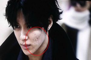 Nggak perlu resah, jerawat ternyata bikin kamu terlihat awet muda