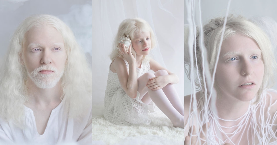 11 Potret orang albino ini eksotis banget, indahnya bikin takjub