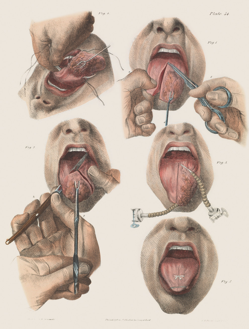9 Ilustrasi gambarkan seramnya proses operasi bedah orang zaman dulu