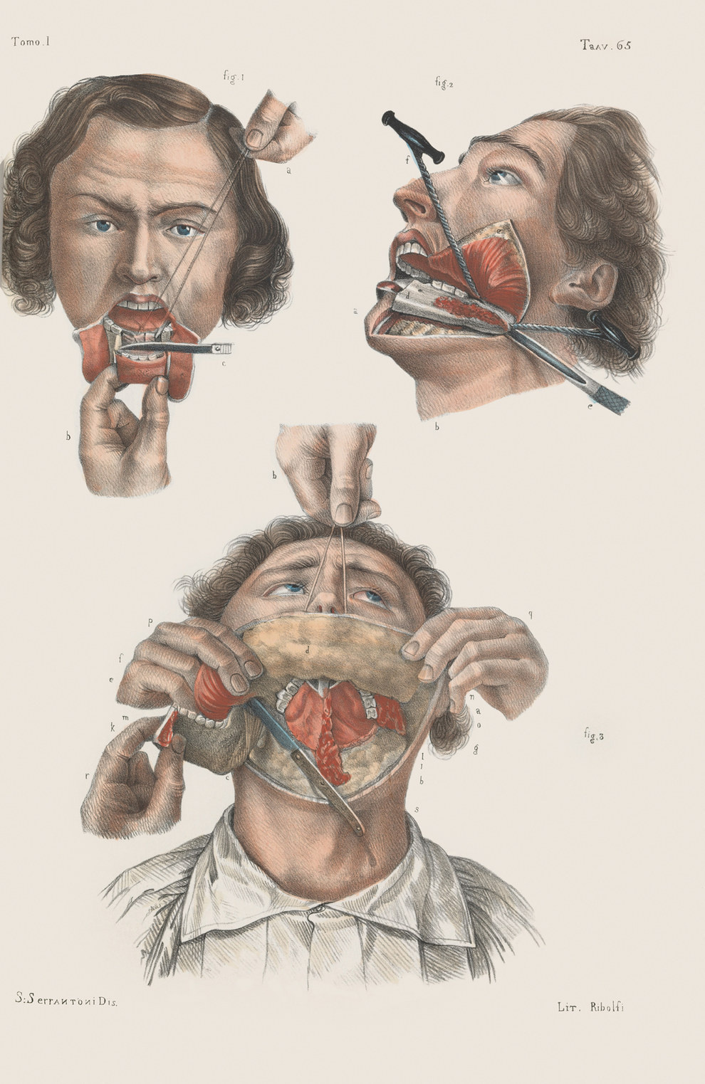 9 Ilustrasi gambarkan seramnya proses operasi bedah orang zaman dulu
