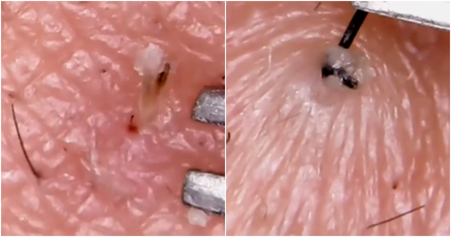 Video blackhead komedo yang berhasil dicabut, menjijikkan ya?