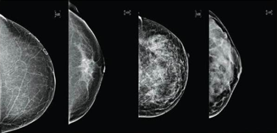 Teknologi terbaru ultrasonik lebih akurat deteksi kanker payudara