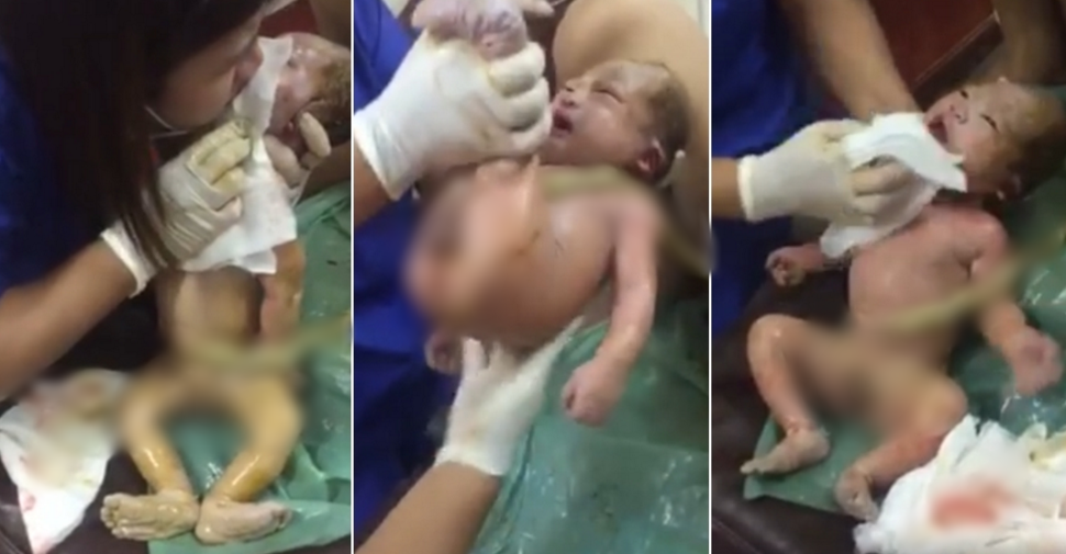 Usaha dokter selamatkan bayi ini bikin tegang dan air mata menetes