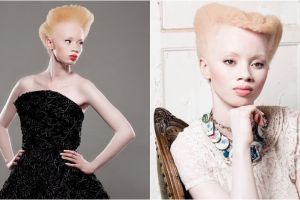 Thando Hopa, model albino sekaligus pengacara sukses dari Afrika