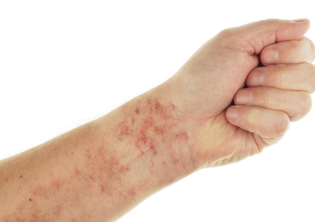 sikat berdarah © 2017 brilio.net sikat berdarah © 2017 brilio.net